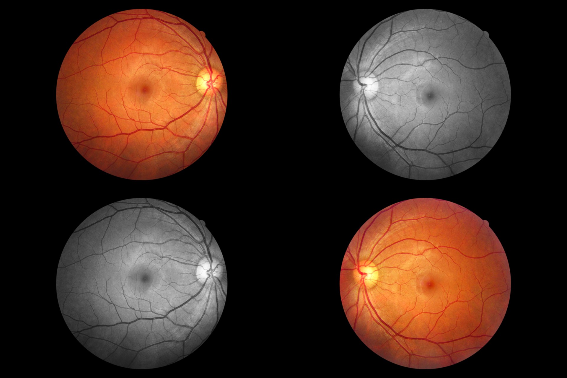 Eye Injection - Canberra Ophthalmology